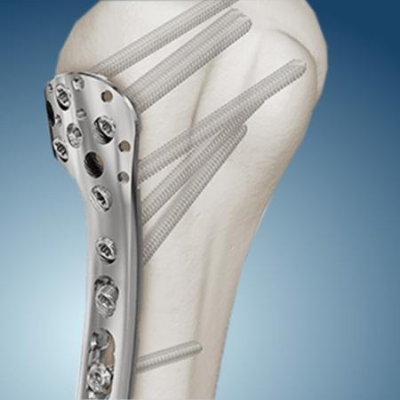 Блокированный накостный остеосинтез ООО "Титанмед"